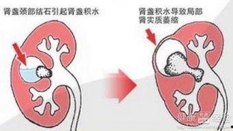 肾积水吃瓜,缓解不适